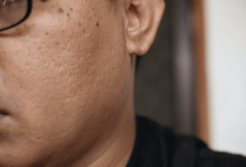 LDM 효과? 여름 피부는 물방울 리프팅! 초음파 물방울 리프팅 LDM이란?