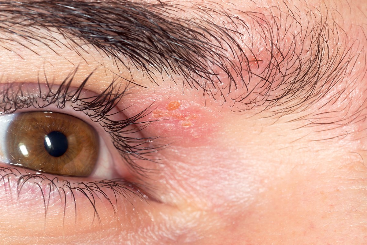 around the shingles of the eyes