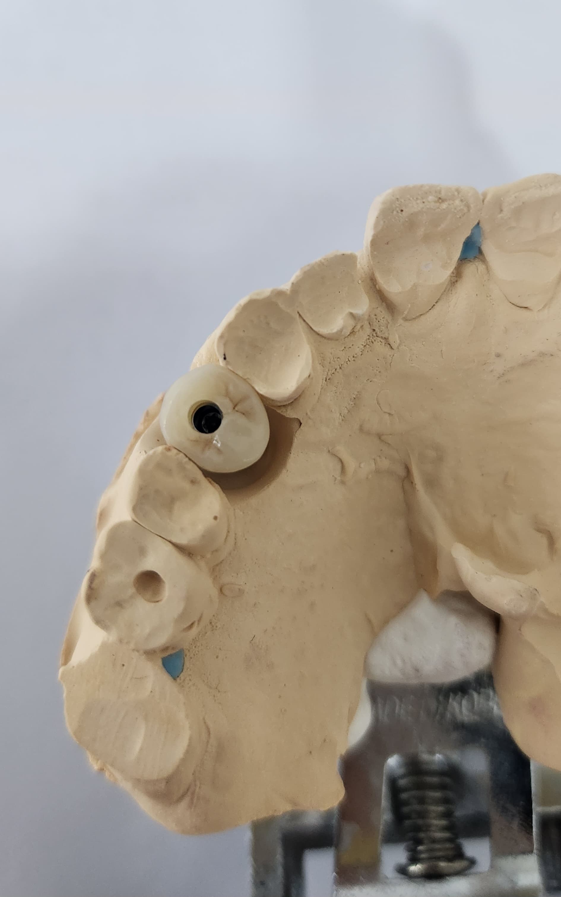 임플란트 크라운 종류