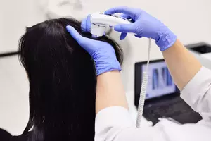 두피-지루성-피부염-치료