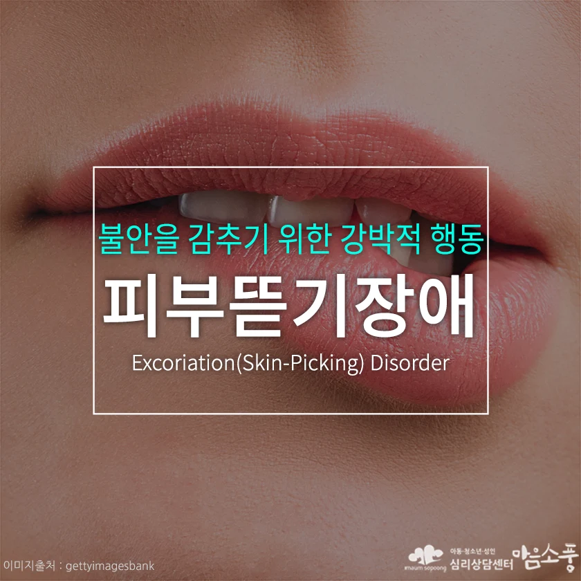 피부뜯기장애, 불안을 감추기 위한 강박적 행동 [심리상담센터 마음소풍] 포스트 썸네일