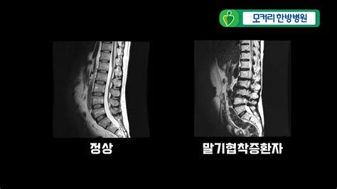 경추협착증