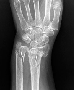 손목뼈(요골) 골절