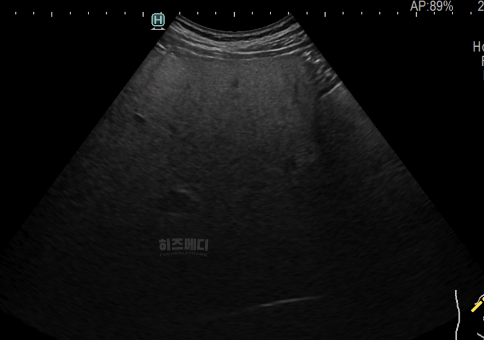 AST ALT 수치 상승