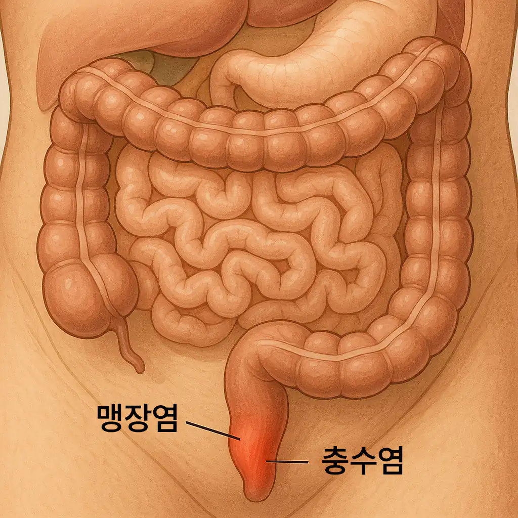 맹장 위치를 강조한 복부 단면 해부 일러스트. 충수돌기에 염증이 생긴 모습