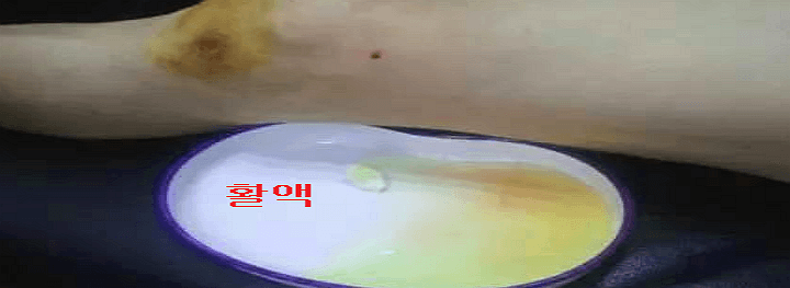 무릎에서 빼낸 물