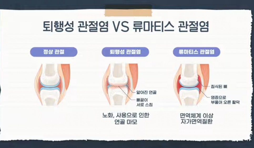 EBS명의-류마티스-관절염-김완욱교수-주지현교수-명의
