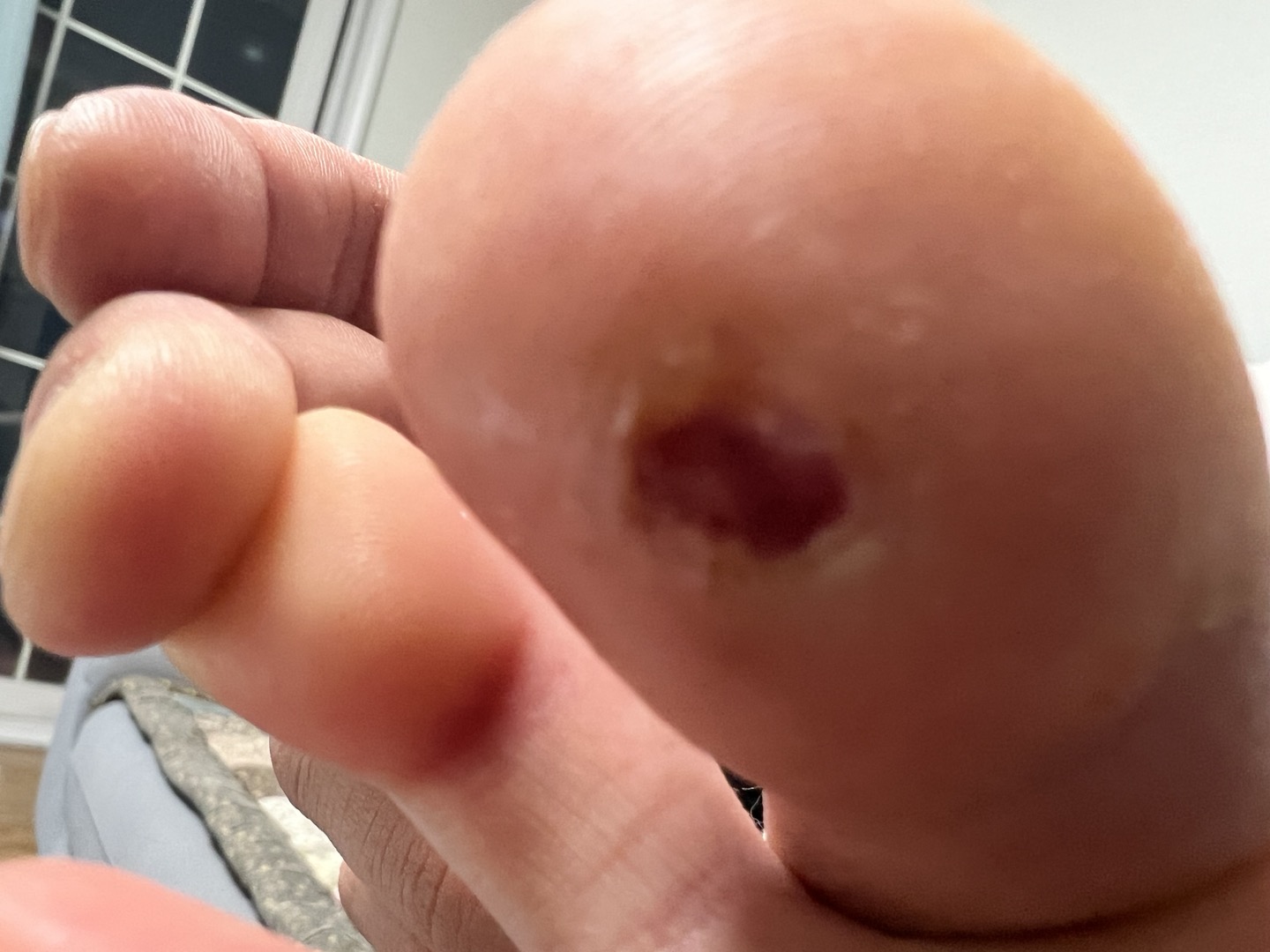 사마귀수술후 사진