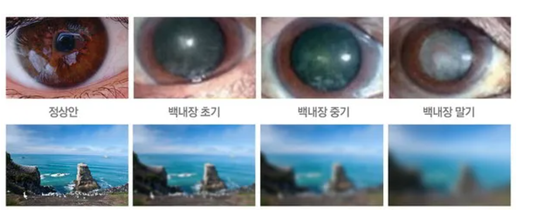 백내장
