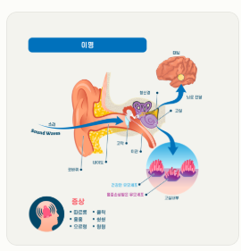 이명 증상 원인 치료방법