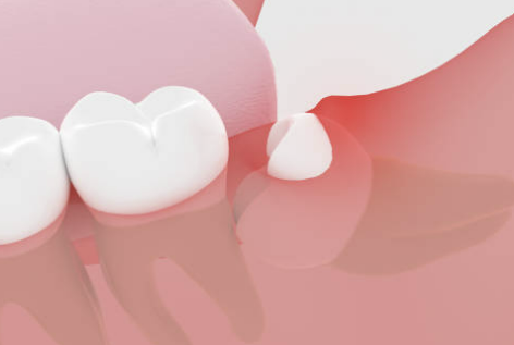 사랑니 발치후 식사 주의사항 가이드