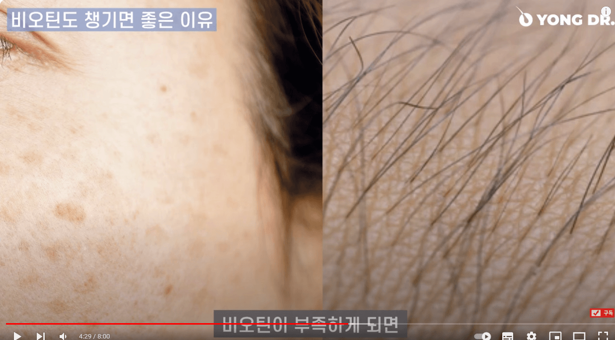 탈모에 