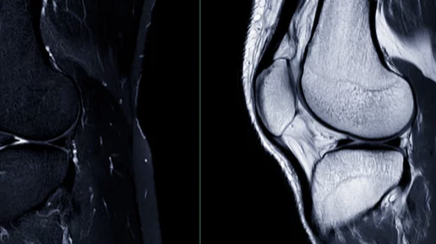 무릎 연골 손상