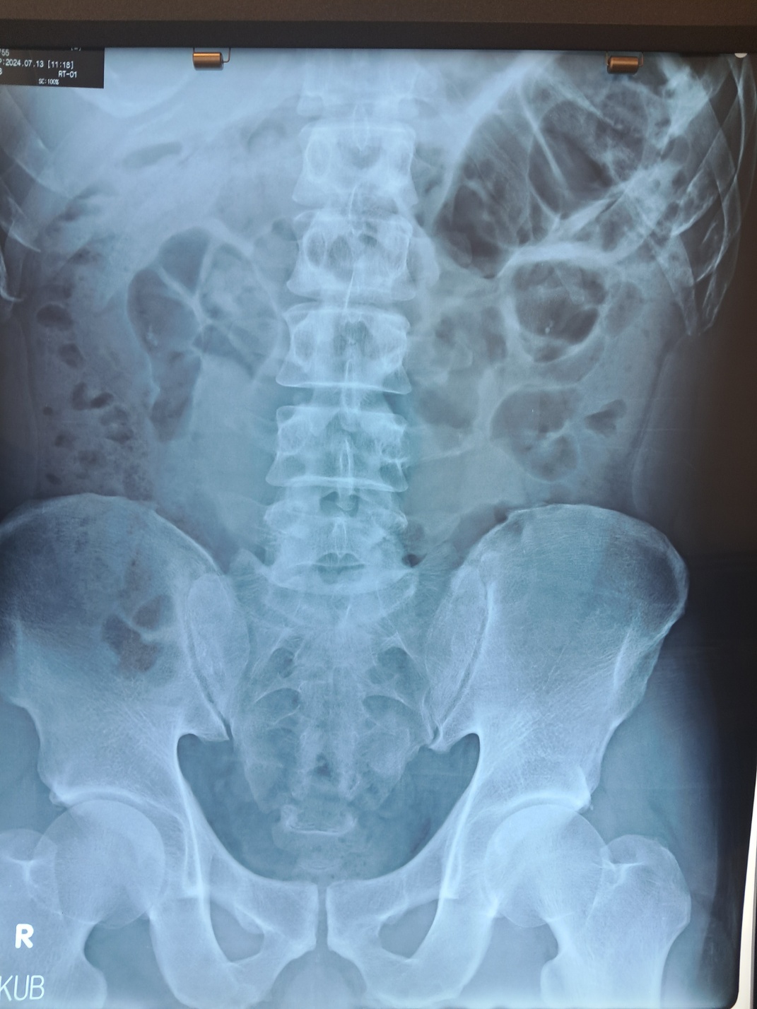 요로결석 엑스레이 사진