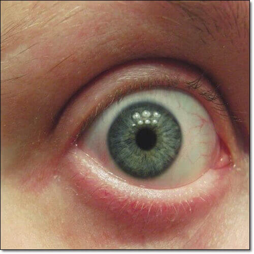 그레이브스병 증상