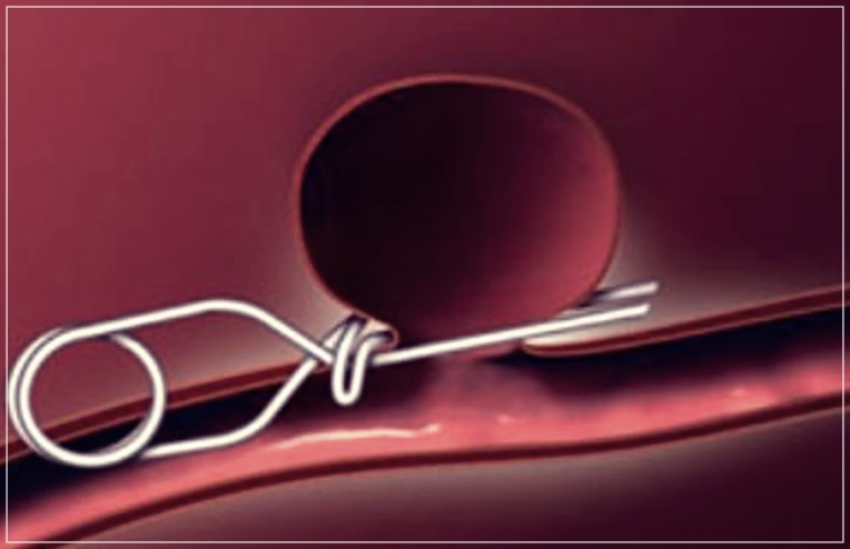 코일색전술 보험: 비용, 재발 위험, 보험의 중요성에 대해 알아보기