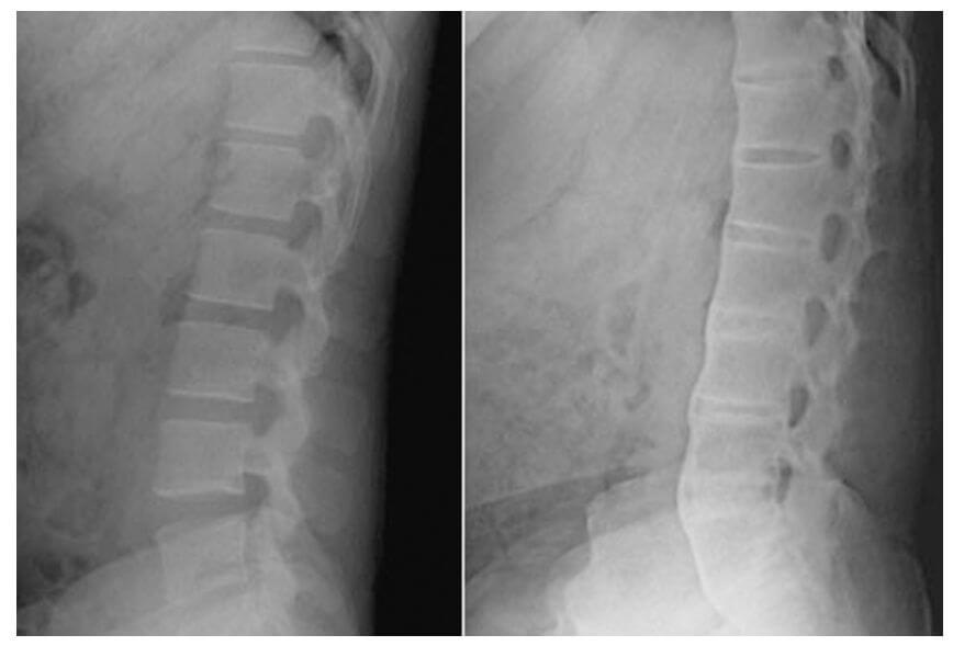 강직성 척추염 증상-치료-수술- 완치