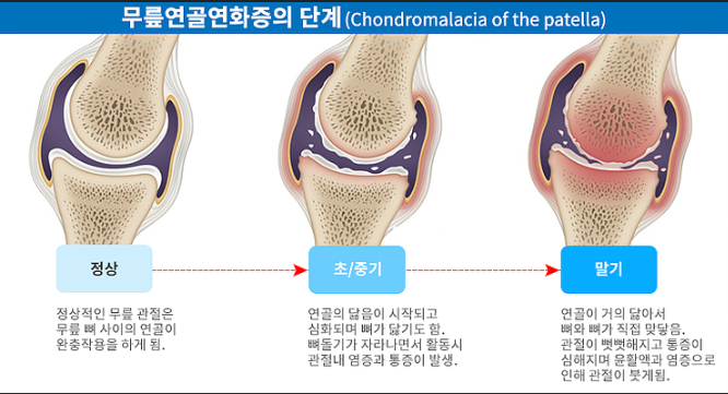 무릎 연골 연화증의 단계