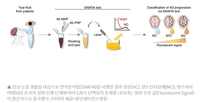 안과검사로 알츠하이머 조기 발견 가능성 관련 이미지