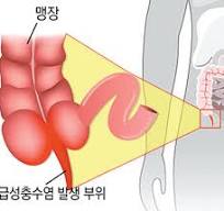 맹장염 증상과 원인