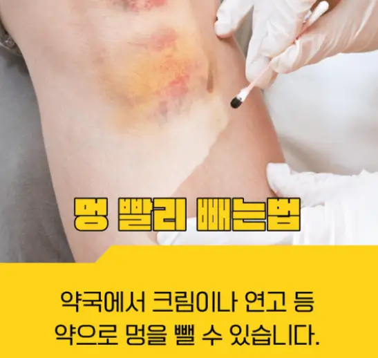 타박상-찜질하는방법