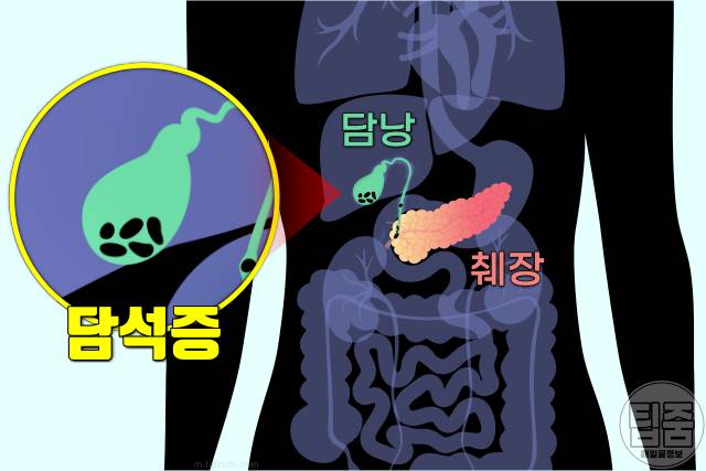 우루사 효능 간영양제 udca 효과 담석증