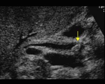 담관염(Cholangitis)