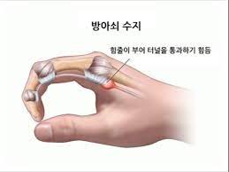 방아쇠수지 증후군 기사 이미지