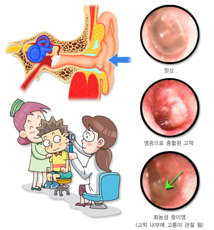 중이염 진단과 검사