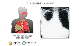 폐에 물이 차는 원인 증상 물참 관리 포인트에 대한 건강정보_6