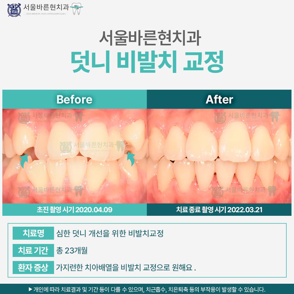 부산치아교정