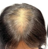 쏘팔메토의 효능