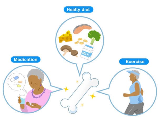 2025년 골다공증에 좋은 영양제 BEST-5 뼈 건강을 위한 확실한 선택