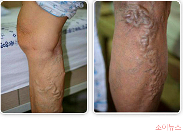하지정맥류가 발생한 모습_출처:국가건강정보포털