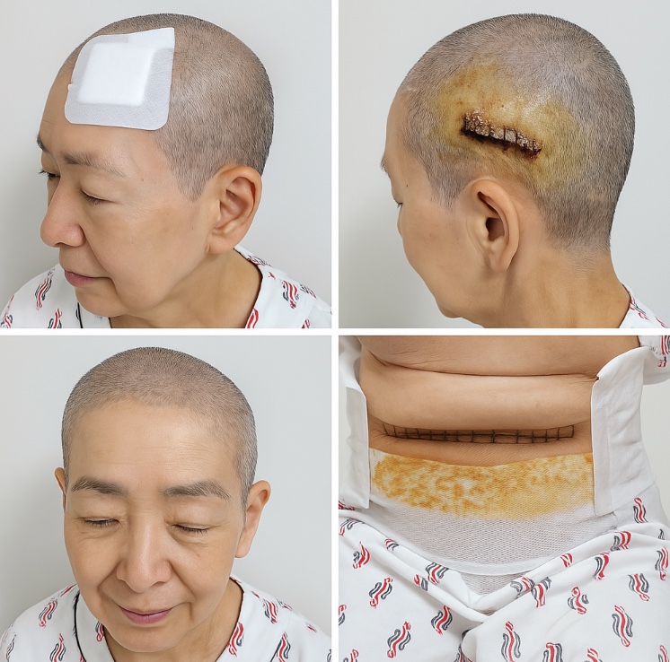 수술부위사진
