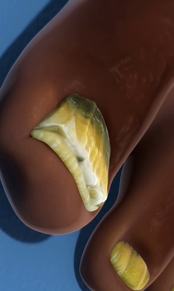 발톱이 검게 변하는 이유