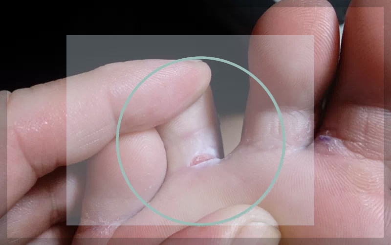 발가락 사이 갈라짐