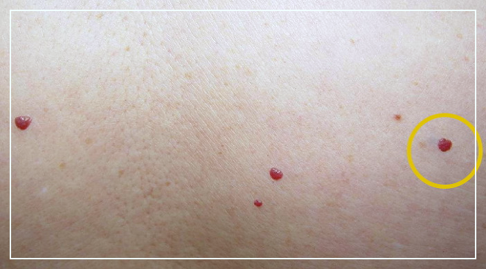 몸에-빨간점이-생기는-이유