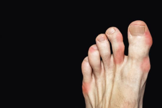 염증성 관절염 (Inflammatory Arthritis)
