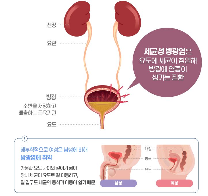 약국 방광염약 여성들의 상비약, 요비신(용담사간탕)에 대해 가격까지 자세하게 정리