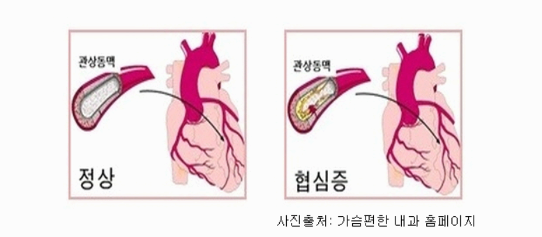 협심증 증상 초기부터 진행 단계까지 반드시 알아야 할 징후 정리