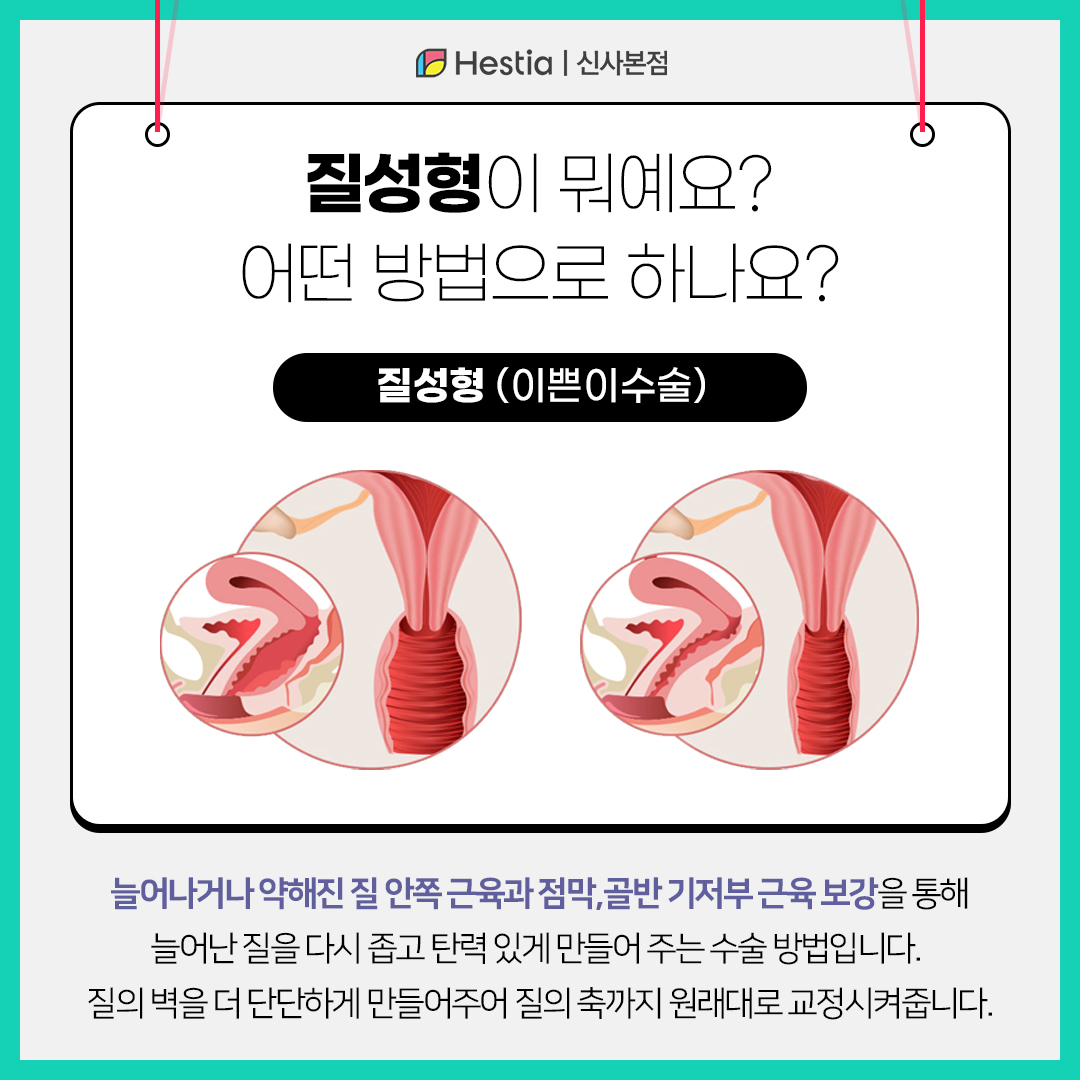 질성형이 뭐죠? 어떤 방법으로 진행되나요?