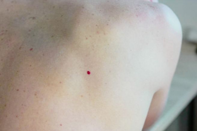 자반증 초기증상