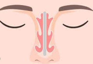 비중격만곡증-증상-치료-수술비용