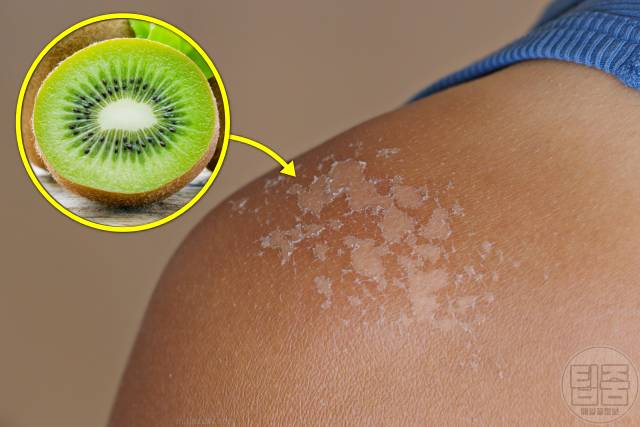 피부 탔을때 하얗게 얼굴 탄거 복구 음식 키위