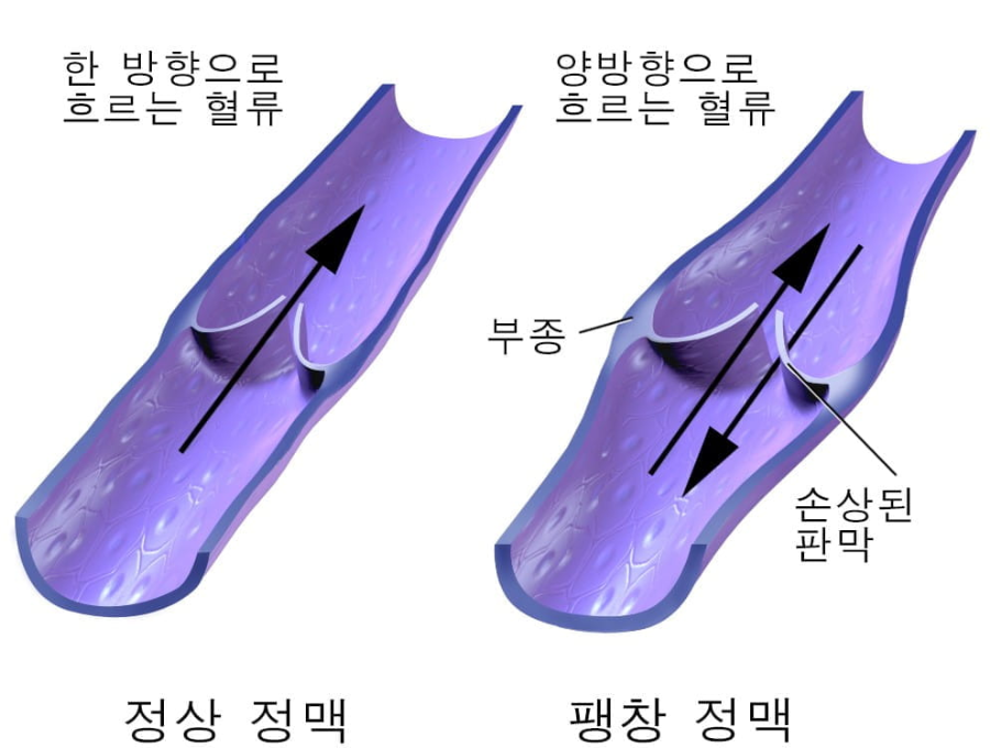 하지정맥류