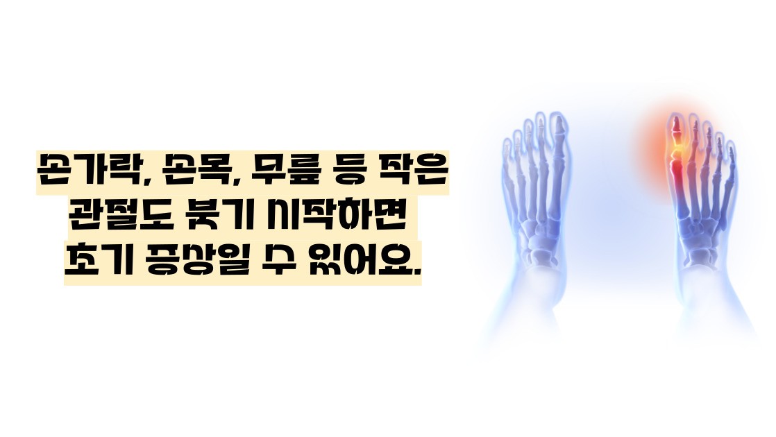 류마티스 관절염 초기증상