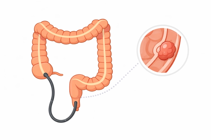 대장암 초기증상