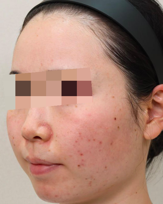 동안 얼굴 만들기 논현동 여드름 피부과