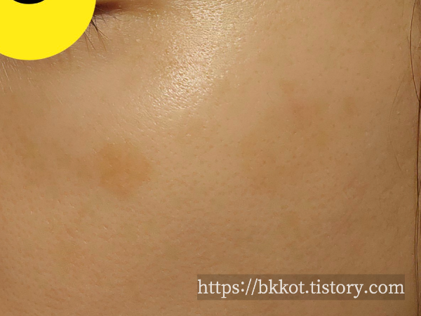 흑자제거 리팟레이저 후기